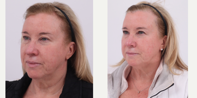 55-64 year old woman treated with BroadBand Light (BBL) - before and after 2 BBL treatments to address rosacea and uneven skin tone.