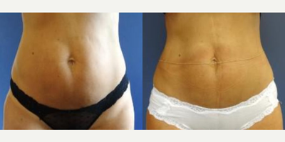 Woman treated with SculpSure - Woman treated with SculpSure
