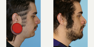 25-34 year old man treated with Ear Lobe Surgery - This patient was ready to fix his earlobes. Dr. Balikian was able to transform his ears after one earlobe surgery.