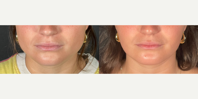 18-24 year old woman treated with Botox for TMJ - The before and after photos illustrate the remarkable effects of Botox treatment for TMJ (temporomandibular joint disorder) and jawline slimming. In the before image, the patient exhibits signs of TMJ discomfort, including facial muscle hypertrophy, noticeable jaw clenching, and a wider jawline due to overactive masseter muscles. The after photo highlights significant improvements following Botox injections. The treatment has effectively relaxed the overactive jaw muscles, leading to a slimmer, more contoured jawline and reduced muscle tension. This not only enhances the patient's appearance but also alleviates the pain and discomfort associated with TMJ. Botox works by temporarily paralyzing the muscles responsible for clenching and grinding, thereby providing relief and promoting a more balanced facial structure.