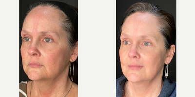 45-54 year old woman treated with Opus Plasma, Skin Tightening, Skin Rejuvenation - This is 2 weeks after having 1 Opus Plasma treatment.