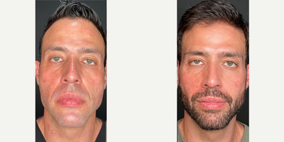 35-44 year old man treated with Collagen Injection, Cheek Fillers, Skin Rejuvenation - This is 4 weeks after having 2 vials of Sculptra.
