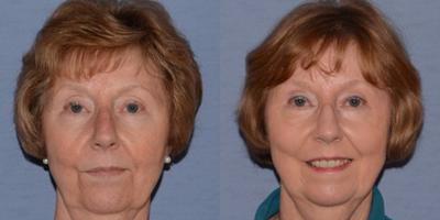 J-Plasma Helium Based Facial Resurfacing - J-Plasma facial rejuvenation resurfacing of spots, wrinkles and different pigments