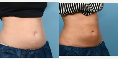 25-34 year old woman treated with Cryolipolysis - 1 session of CoolSculpting for the abdomen.