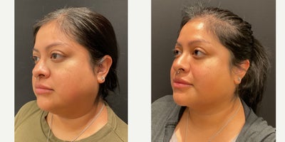 25-34 year old woman treated with Buccal Fat Removal, Renuvion, Chin Liposuction - Buccal fat pad removal with submental chin liposuction and Renuvion.