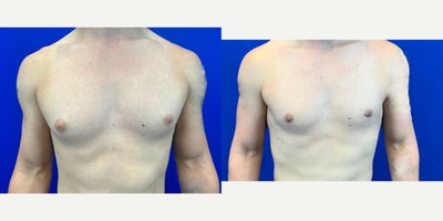 25-34 year old man treated with Breast Reduction - This patient presented with desire to improve the appearance of his chest. Despite being very fit, he disliked the protrusion beneath his nipple/areolar complex. This concern was present for several years. He underwent a bilateral gynecomastia procedure.