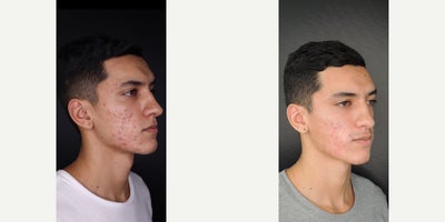 18-24 year old man treated with Skin Rejuvenation, Microneedling RF, Morpheus8, CO2 Laser, Fraxel Laser, Scar Removal - Scar revision, combined laser and microneedle RF therapy