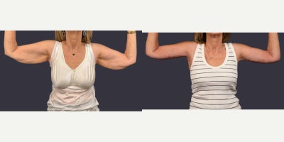 55-64 year old woman treated with Arm Lift - A 61 year old, 5'5 woman, weighing 143 pounds presented requesting an arm lift. A brachioplasty was performed to improve the loose skin of the upper arms. Her results are shown at 3 months.