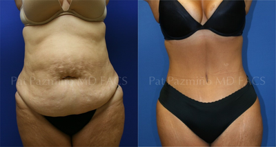 Tummy tuck - 
	Tummy tuck before and after
