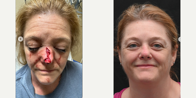 Woman treated with Facial Reconstructive Surgery - As a facial plastic surgeon, I am truly honored to provide care for patients during some of their toughest moments, which is often the case with facial trauma.This amazing woman was in a car accident on Mothers Day, suffering traumatic fractures and lacerations to her nose. We were able to repair her injuries and she has done a fantastic job with her recovery as demonstrated by her photos immediately after the injury and at her 1 month follow-up. She still has some healing to do, but has already come a long way! I am so grateful to be part of her team and look forward to helping with her journey to recovery.