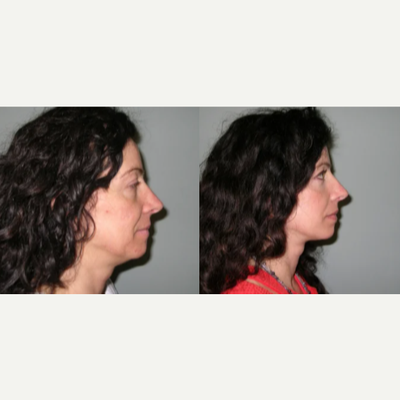 Woman treated with Facelift - This patient was unhappy with the effects of facial aging. She underwent facelift/neck lift surgery, endoscopic brow lift and lower blepharoplasty.