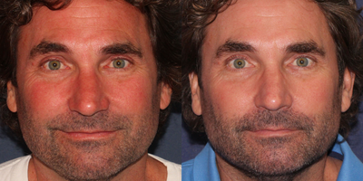 57 year old man treated with V Beam Perfecta - Dr. Groff treated this 57 year old man only one time with the V Beam Perfecta. Notice the dramatic decrease in overall redness, broken capillaries, and rosacea.