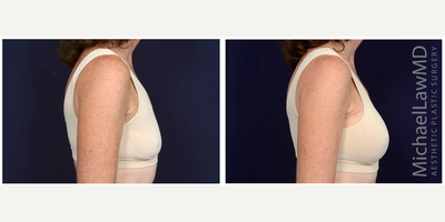 55-64 year old woman treated with Natrelle Breast Implants - Breast augmentation. Follow-up photos taken 1 month after the procedure.