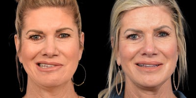 45-54 year old woman treated with Facial Reconstructive Surgery - Before & After Facial Reanimation for Bells Palsy: Selective Neurolysis Symmetrical Facial Repositioning and Blepharoplasty for Symmetry
