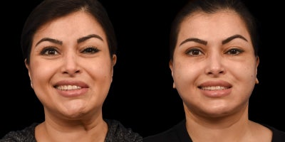 35-44 year old woman treated with Facial Reconstructive Surgery - Before & After Facial Reanimation: Selective Neurolysis for Synkinesis and Facial Paralysis