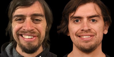 35-44 year old man treated with Facial Reconstructive Surgery - Facial Reanimation Results: Before & After Selective Neurolysis with Platysma Myectomy for Ramsay Hunt Syndrome