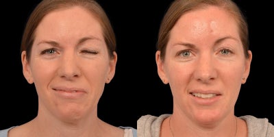 35-44 year old woman treated with Facial Reconstructive Surgery - Before & After Left Selective Neurolysis With Orbicularis Myectomy and Upper Blepharoplasty