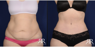35-44 year old woman treated with Diastasis Recti Repair - Diastasis Recti Repair