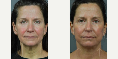 Woman treated with Facelift - Woman treated with Facelift