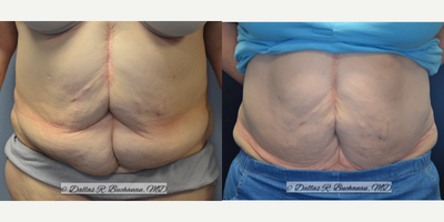 56 year old woman treated with Panniculectomy - 56 year old female who underwent gastric bypass in 2010. She lost 70 pounds and presented with problems with skin irritation and wetness in the waistline folds. She was unable to pursue cosmetic options for abdominal contouring due to financial constraints. She chose to proceed with insurance-approved panniculectomy with removal of the skin below the waistline only with no surgical efforts to address abdominal contour or aesthetic appearance. She had improvement in skin irritation and was pleased with the outcome. A full abdominoplasty (tummy tuck) or fleur-de-lis abdominoplasty would have produced additional skin removal and far superior aesthetic outcomes, but these procedures are not covered by insurance and are considered cosmetic and involve out-of-pocket costs.