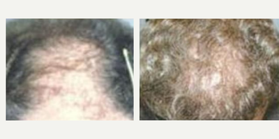 Man treated with Hair Transplant - Man treated with Hair Transplant