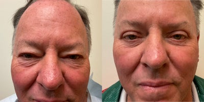 55-64 year old man treated with Eyelid Surgery - 6 weeks post upper & lower Blepharoplasty