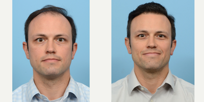 35-44 year old man treated with Hair Transplant, Hair Loss Treatment, PRP for Hair Loss, FUE Hair Transplant, NeoGraft - Dr. Wise performed an FUE hair transplant on this patient with 3,510 grafts and one treatment of PRP. 1 year post-op the patient's results exceeded his expectations.