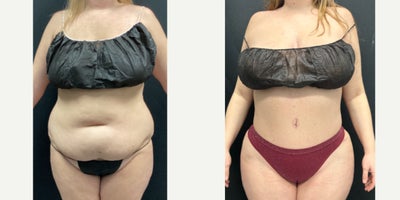 35-44 year old woman treated with Diastasis Recti Repair, Liposuction - Patient presented for a tummy tuck with rectus diastasis repair and liposuction.
