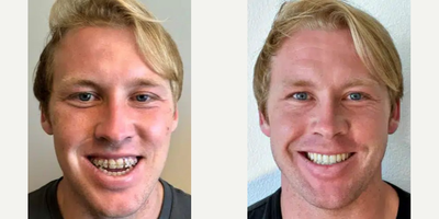 Man treated with Jaw Surgery - Man treated with Jaw Surgery