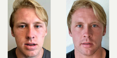 Man treated with Jaw Surgery - Man treated with Jaw Surgery