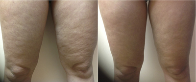 ThermiTight - Before and after photos courtesy of ThermiTight, Karen Harkaway, MD