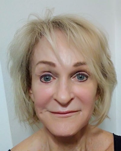 Fibroblast Plasma Pen Laser Treatment Review Realself