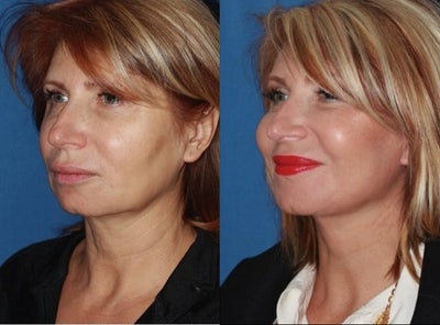 Early Facial Aging Reversed with a Facelift - This patient presents with early signs of facial aging. Jowls, neck skin laxity and loss of youthfull cheek contour are becoming apparent.