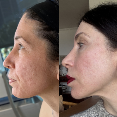 25-34 year old woman treated with CO2 Laser, Halo Laser, Microneedling RF, Subcision - She came back to me after a few years because her skin deserved nothing but the bestand thats exactly what she got. I put her through my worldclass Acne Scar Combo: subcision to break up those tethered scars, RF microneedling for deep collagen remodeling, DeepFX + CO laser for resurfacing, hybrid fractional laser for texture, and of course, EmerSkin to speed up healing and lock in that glow. Now? Her complexion is smoother, more radiant, and absolutely flawless. Shes in love with her resultsand trust me, no one else could have achieved this level of transformation for her.Why EMER SKIN is a gamechanger: