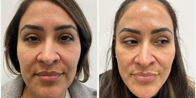 Woman treated with Microneedling, VI Peel, SkinPen - Woman treated with Microneedling, VI Peel, SkinPen