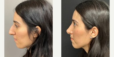 Woman treated with Rhinoplasty - Rhinoplasty