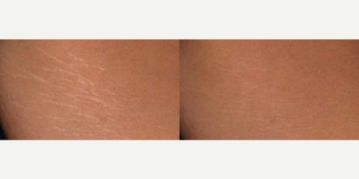 Woman treated with ResurFX - Photo provided courtesy of Lumenis, Ltd., performed by Matteo Tretti Clementoni, MD