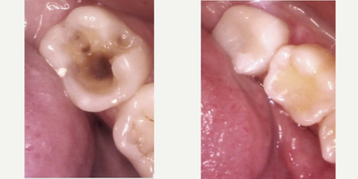 Patient treated with Tooth Repair - What is an ONLAY?Is a dental restoration that is larger than a filling but smaller than a crown.If you have decay on the chewing surface of your tooth that is too large for a filling, you may need an onlay restoration.Advantages of onlaysThese materials are extremely durableInlays and onlays do not stain, while composite resin fillings do.They preserve the natural tooth structure