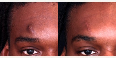 25-34 year old man treated with Scar Removal - Scar Removal to address keloid (hypertrophic scar)