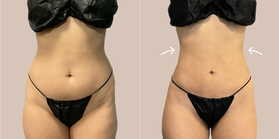 25-34 year old woman treated with AirSculpt - Patient received Stomach Airsculpt Fat removal from our Miami location. Results are only 1 week.