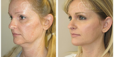 45-54 year old woman treated with Mini Lift - 46 year-old female patient with macs facelift (mini facelift) by Dr. Scott Thompson