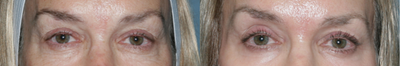 Fraxel Repair to Brighten Eye Area - 
	Patient had Fraxel Repair to rejuvenate the skin around the eyes and brow.

