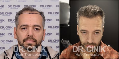 45-54 year old man treated with DHI Hair Transplant - 56 Years Old Male Patient - Norwood V - 4780 Grafts DHI Hair Transplant