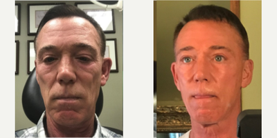 55-64 year old man treated with Silhouette InstaLift - Instalift