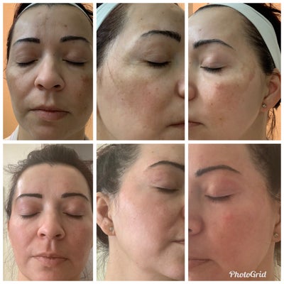 Fighting Melasma For Too Long Review Realself