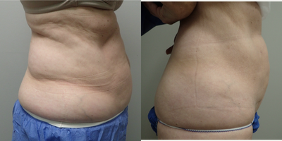 55-64 year old woman treated with Smart Lipo - Patient underwent Smartlipo procedure to treat her abdomen and waist area. The after photo is just 5 days after the procedure.