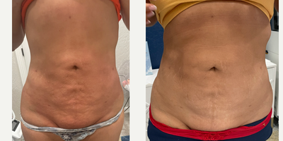 35-44 year old woman treated with Microneedling RF - VirtueRf microneedling. This is 4 weeks after 1st treatment with the DeepRF hand piece.