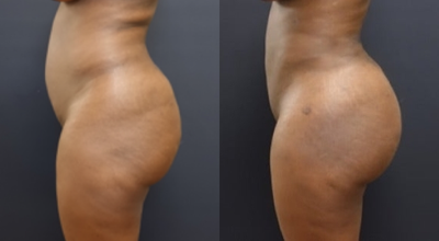 35-44 year old woman treated with Butt Lift - The patient underwent a Brazilian Butt Lift (fat transfer) with 1000cc placed on each side. She also had liposuction of her abdomen, flanks and back to sculpt her waist. The fat was then processed and used to augment her buttock. The combination of the sculpting and fat transfer giver her more of an hour glass figure.