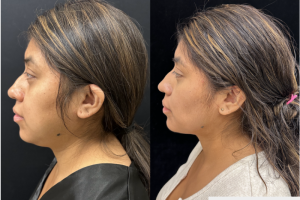 32 year old woman treated with Chin Liposuction - 32 year old woman treated with Chin Liposuction
