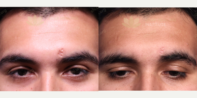 18-24 year old man treated with Subcision - Shingles Scar TransformationOur patient is a young male who had a bad episode of shingles near his upper left eyebrow, leaving behind an ugly scar. We treated his scar with 2 rounds of multi-layered subcision to lift the skin depression. We also instructed the patient to perform at-home suctioning to prevent his freshly treated scar from retethering. As you can see, his scar has elevated to almost the same level as the surrounding healthy skin. All that remains is minor textural irregularities and moderately visible scar demarcations. These residual flaws make him a great candidate for ablative laser resurfacing. However, our patient is already very satisfied with his treatment outcome.